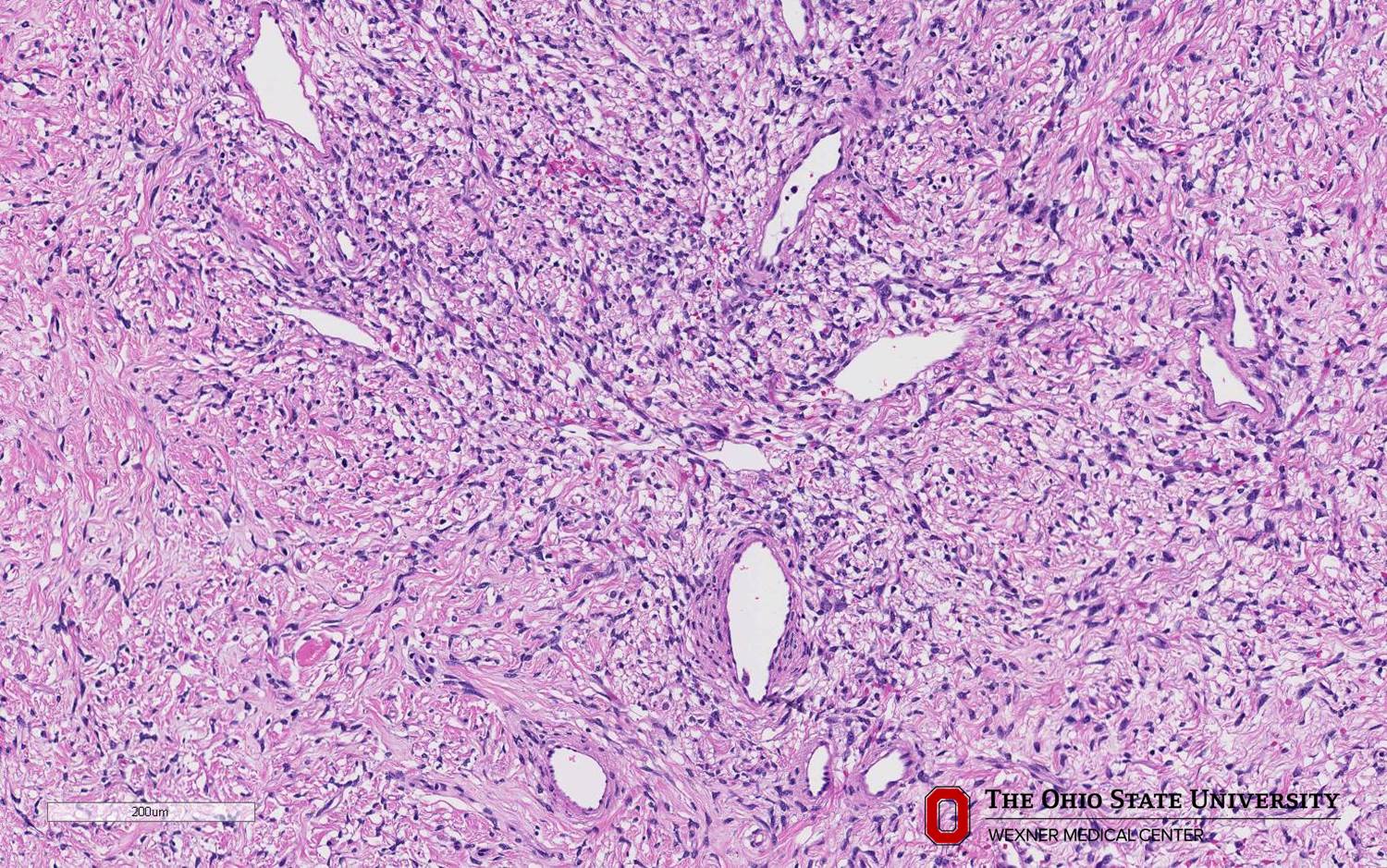 Microscopic image possibly detecting cancerous areas in human tissue