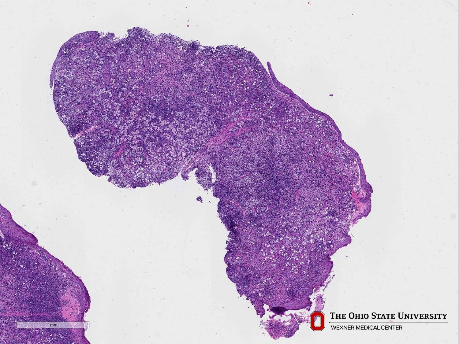 Microscopic image possibly detecting cancerous areas in human tissue