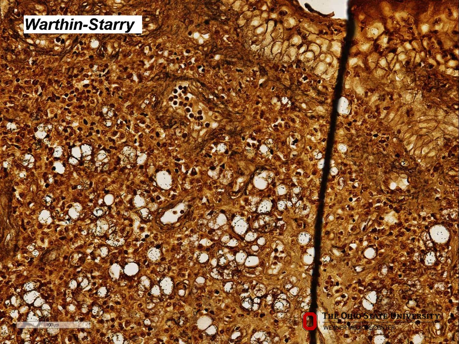 Microscopic image possibly detecting cancerous areas in human tissue