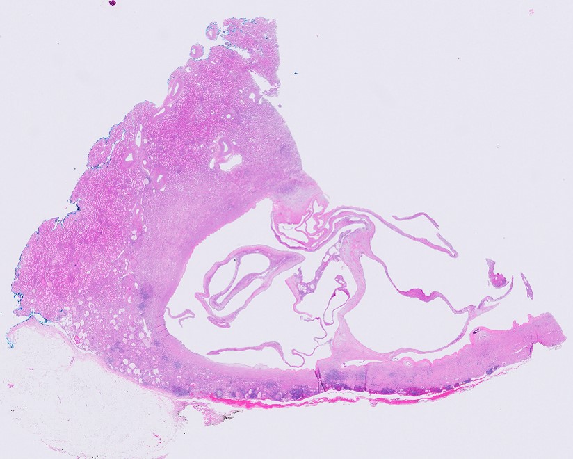 Microscopic image possibly detecting cancerous areas in human tissue