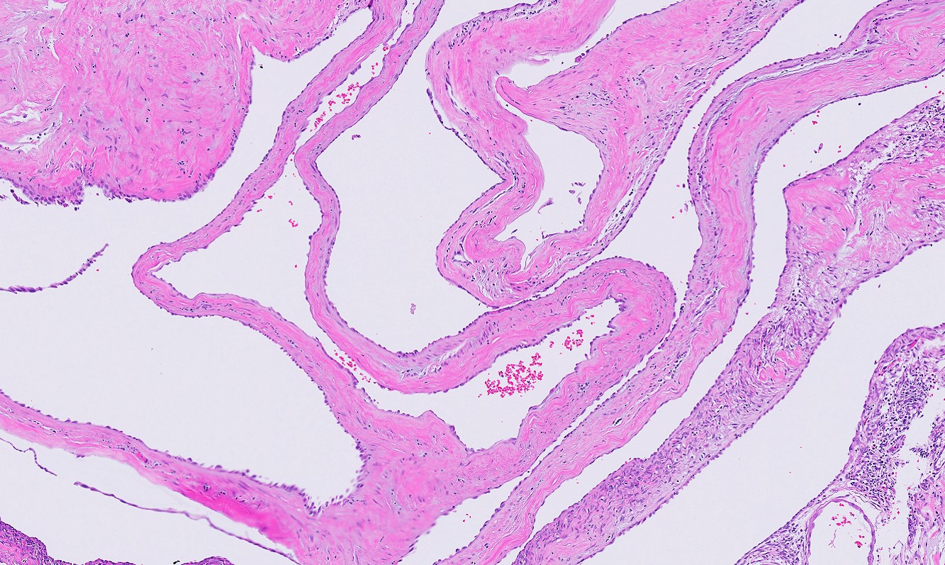 Microscopic image possibly detecting cancerous areas in human tissue