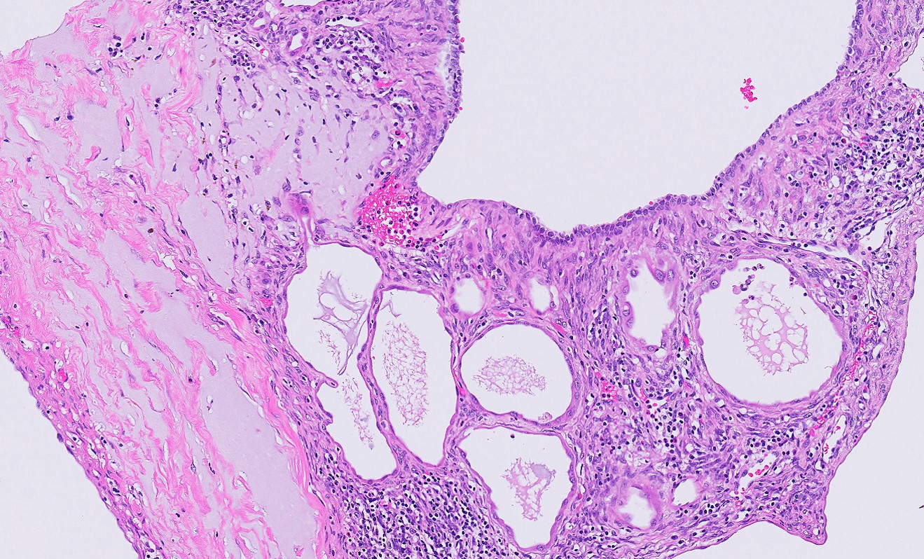 Microscopic image possibly detecting cancerous areas in human tissue