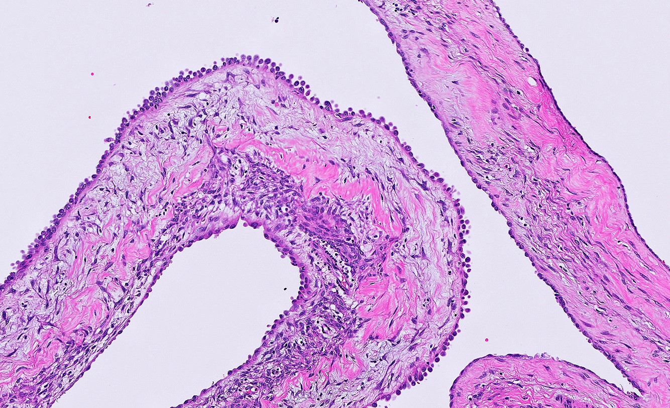 Microscopic image possibly detecting cancerous areas in human tissue