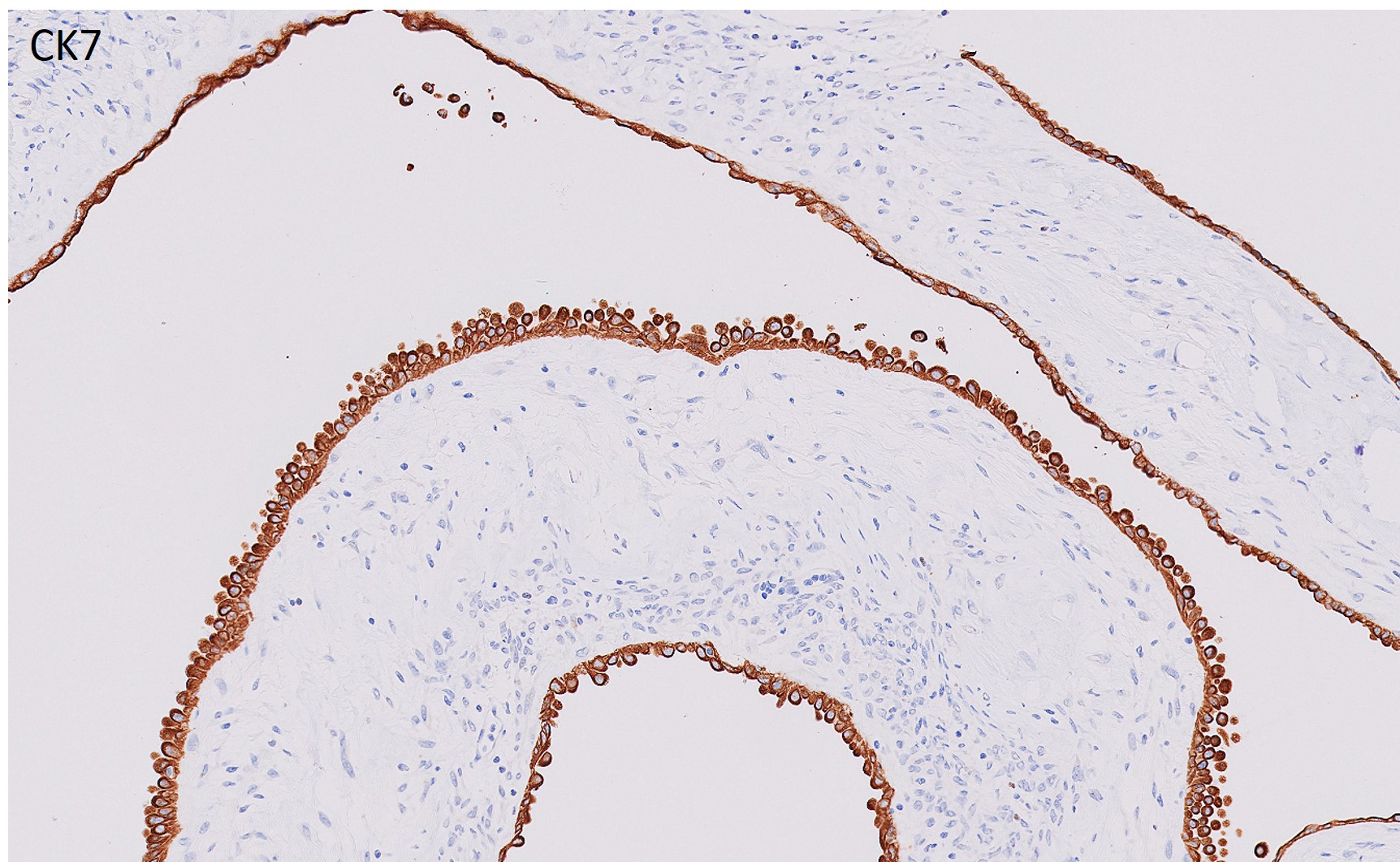 Microscopic image possibly detecting cancerous areas in human tissue