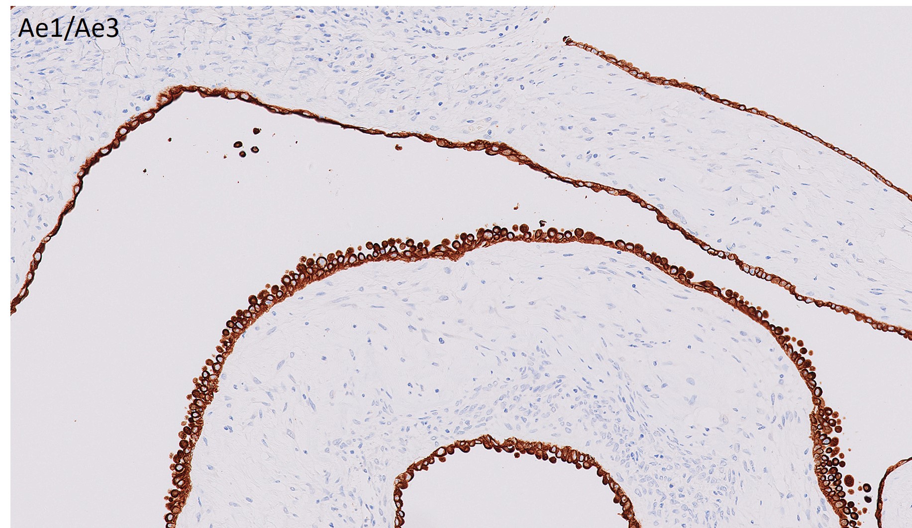 Microscopic image possibly detecting cancerous areas in human tissue