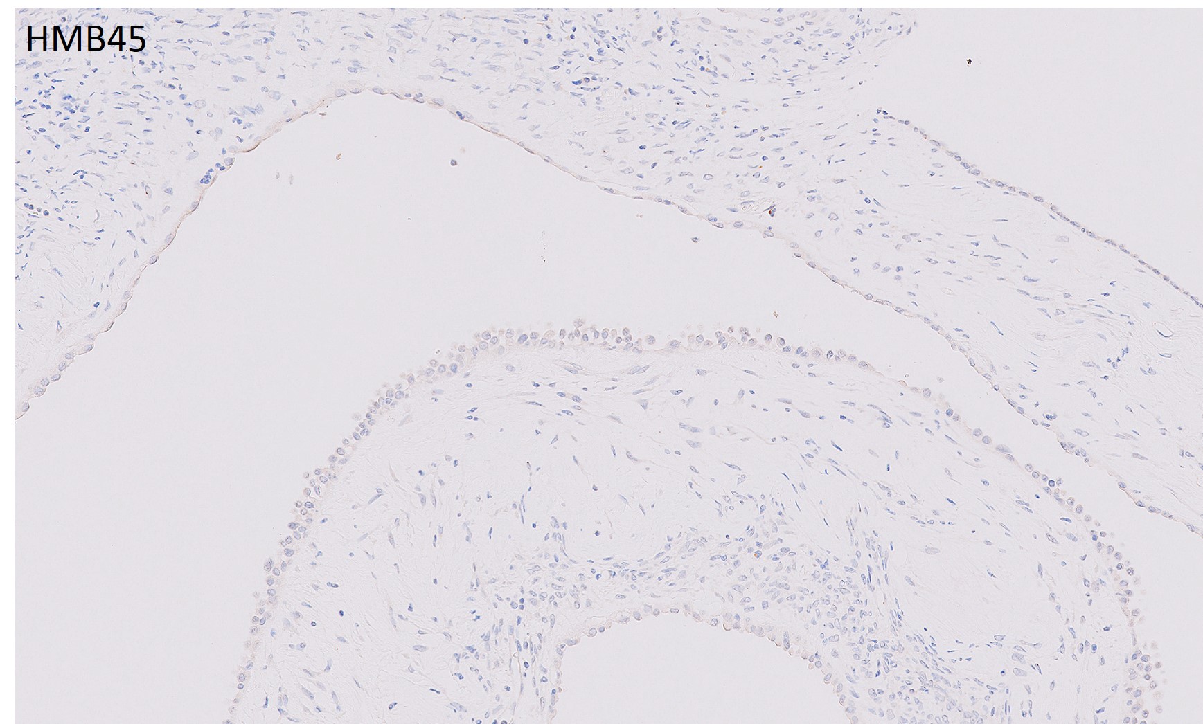 Microscopic image possibly detecting cancerous areas in human tissue