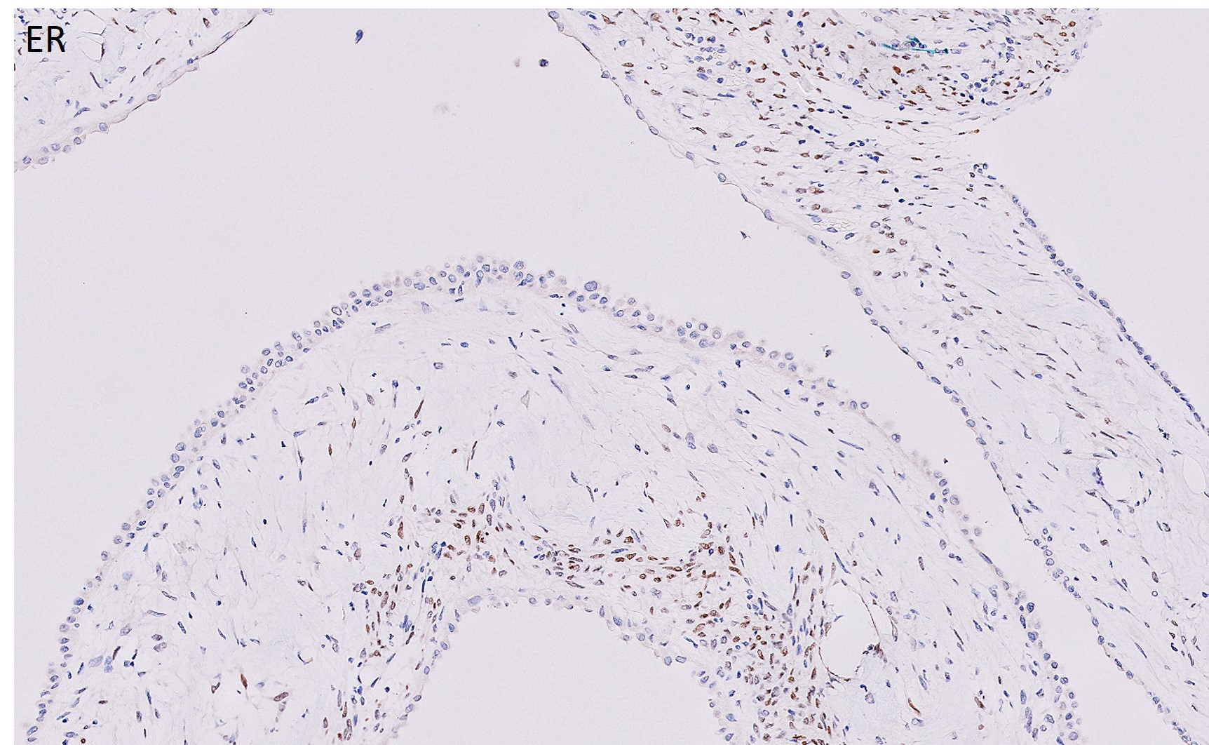 Microscopic image possibly detecting cancerous areas in human tissue