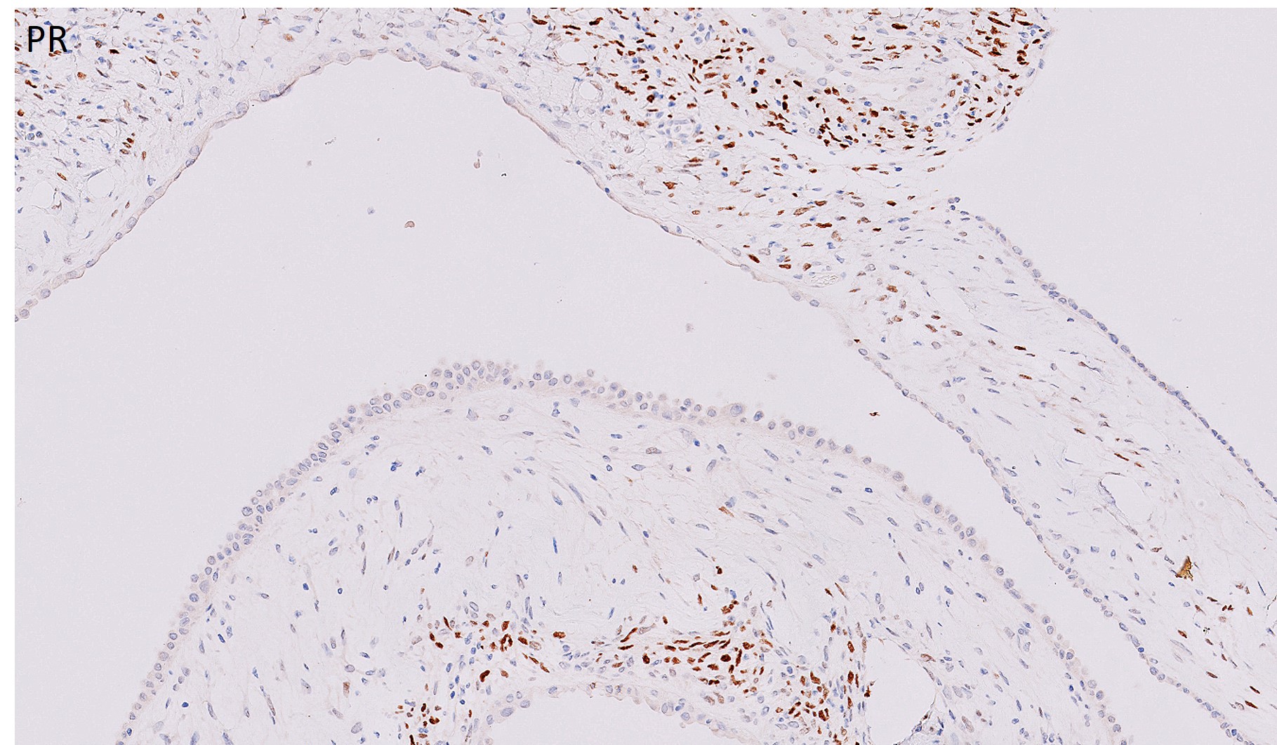 Microscopic image possibly detecting cancerous areas in human tissue