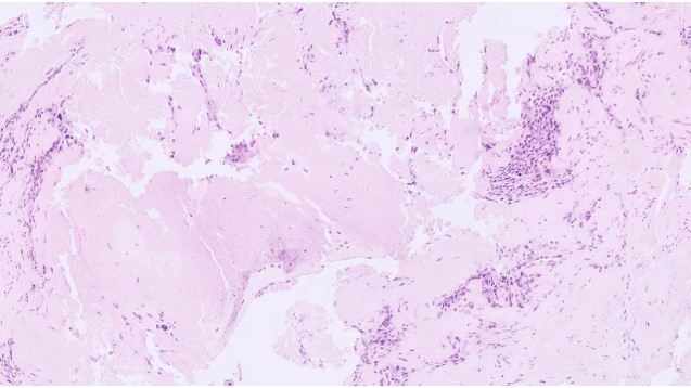 Microscopic image possibly detecting cancerous areas in human tissue