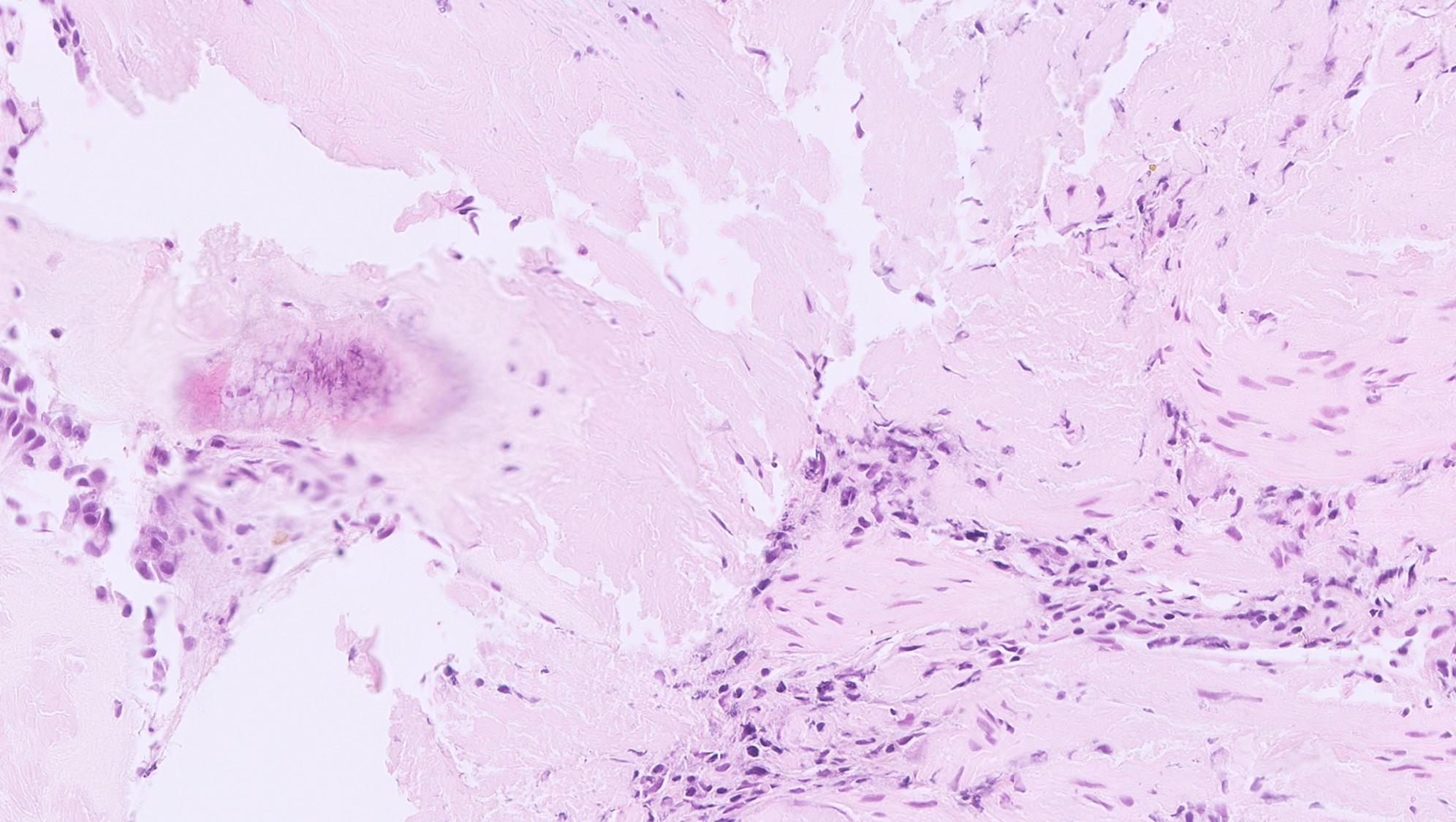 Microscopic image possibly detecting cancerous areas in human tissue