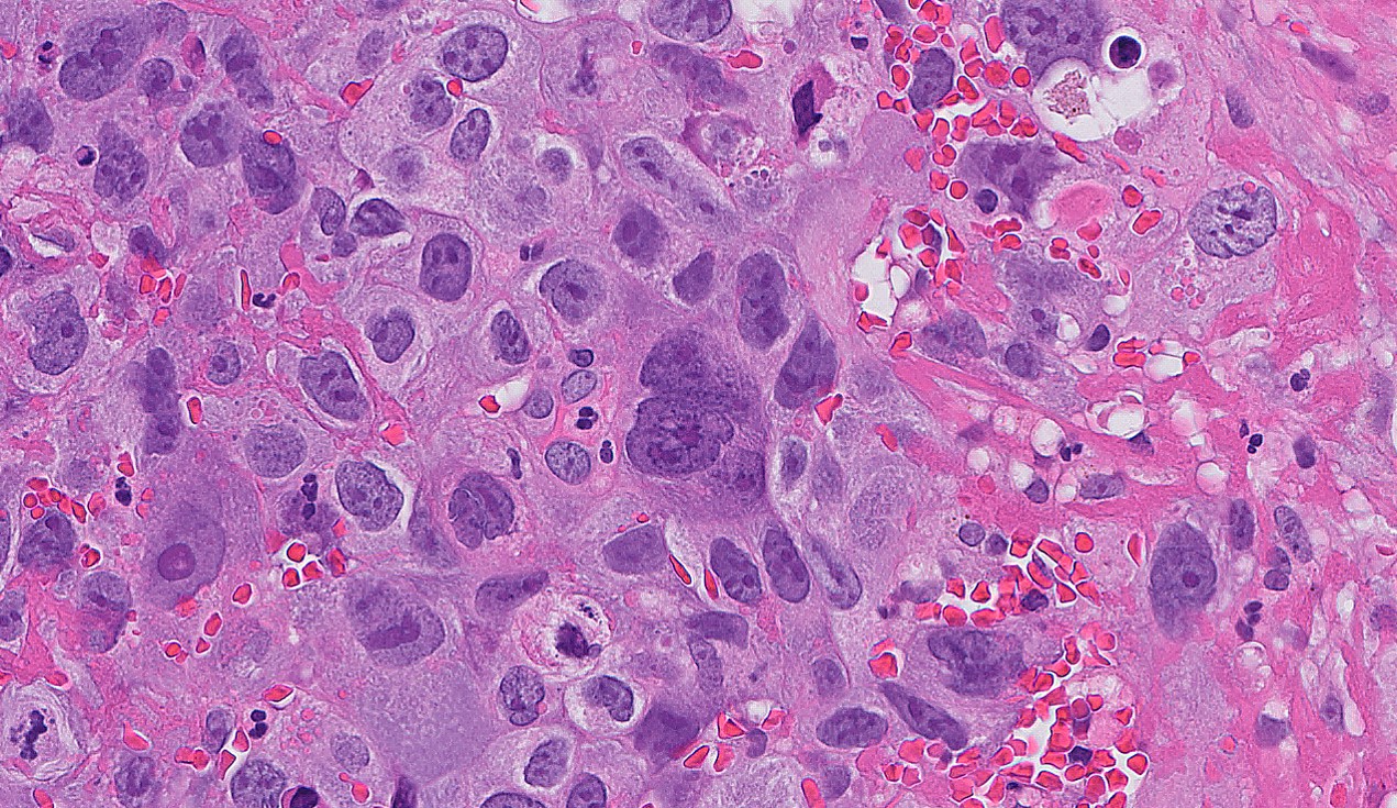 Microscopic image possibly detecting cancerous areas in human tissue