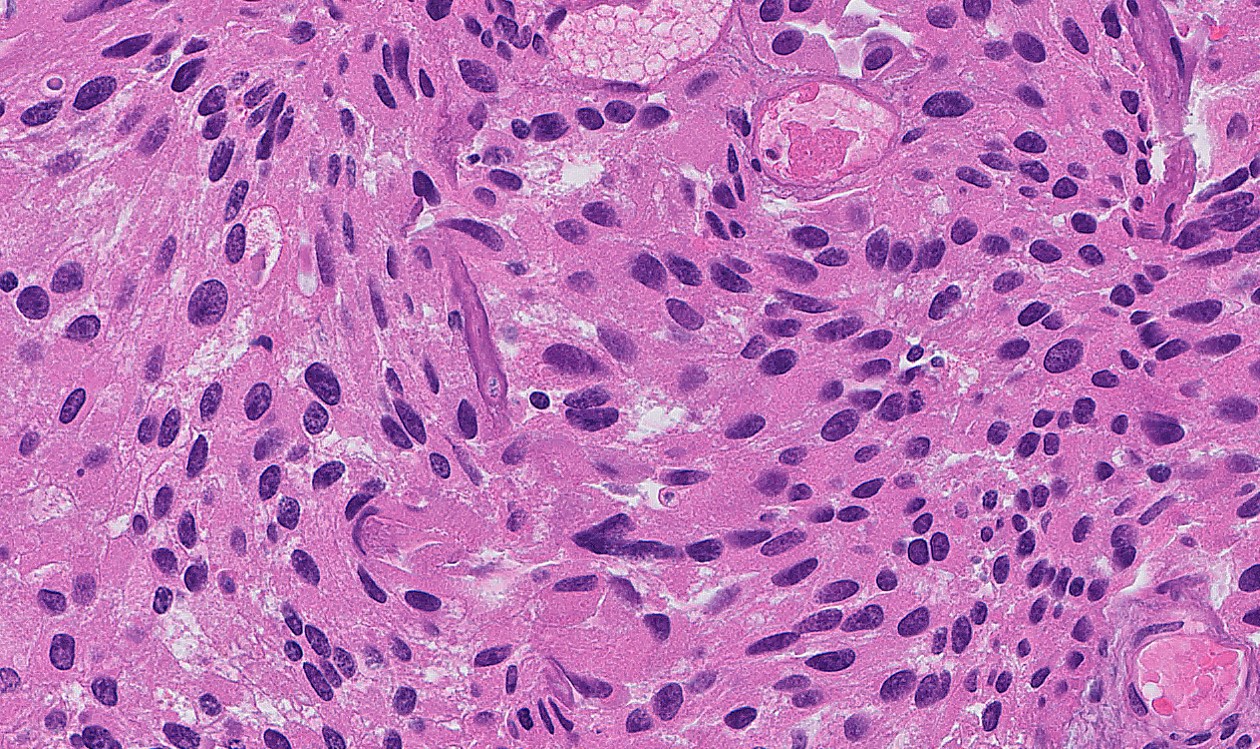 Microscopic image possibly detecting cancerous areas in human tissue