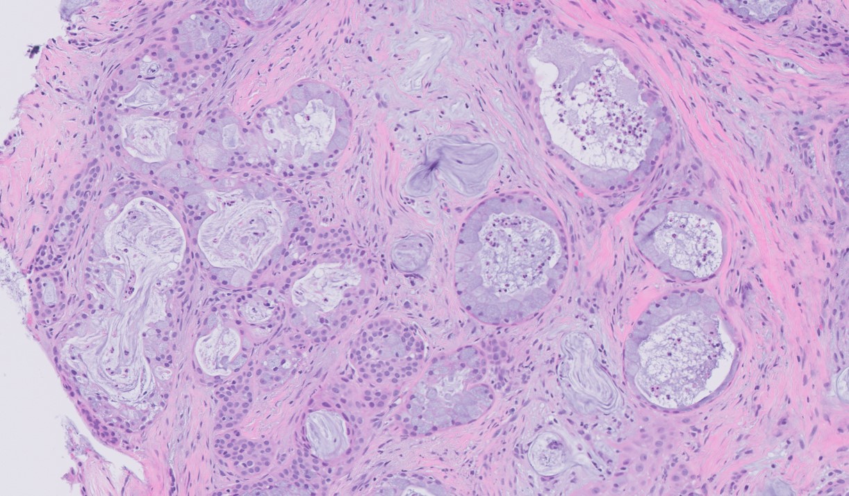 Microscopic image possibly detecting cancerous areas in human tissue