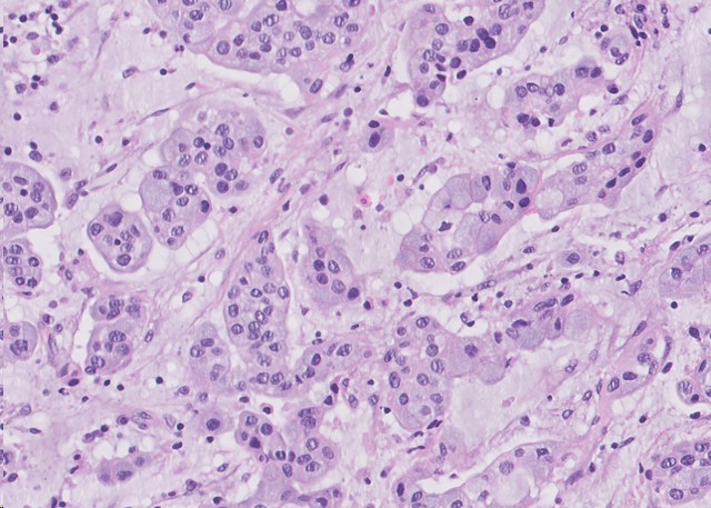 Microscopic image possibly detecting cancerous areas in human tissue