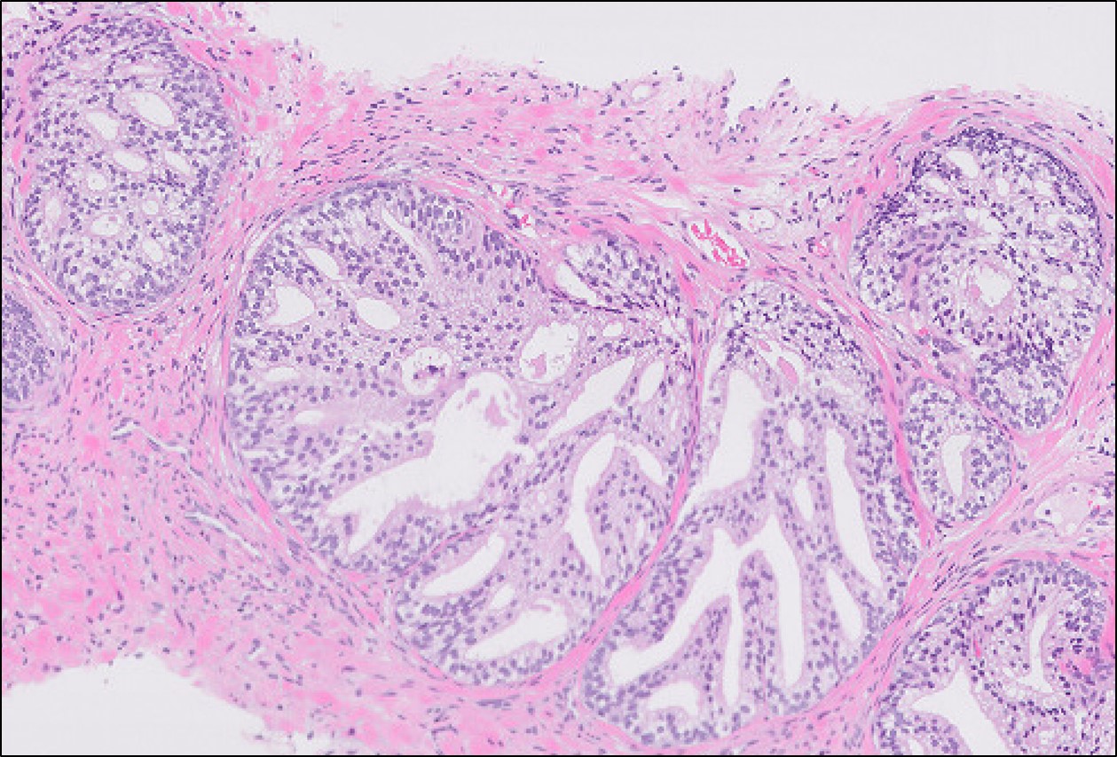 Microscopic image possibly detecting cancerous areas in human tissue