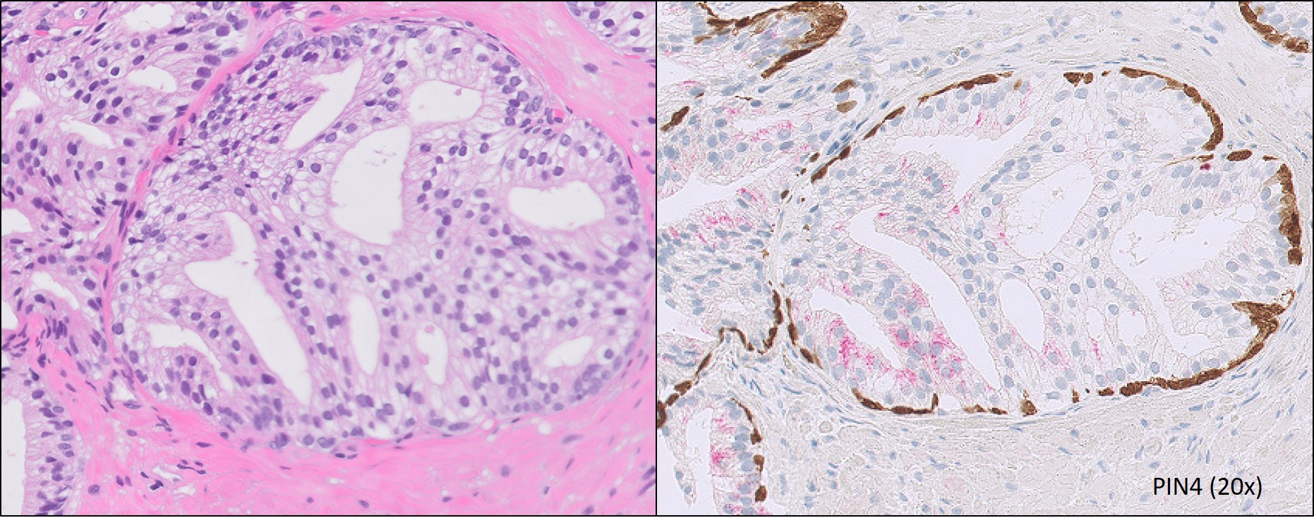 Microscopic image possibly detecting cancerous areas in human tissue