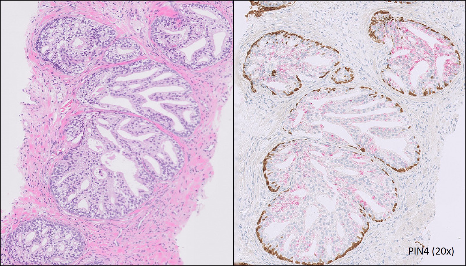 Microscopic image possibly detecting cancerous areas in human tissue