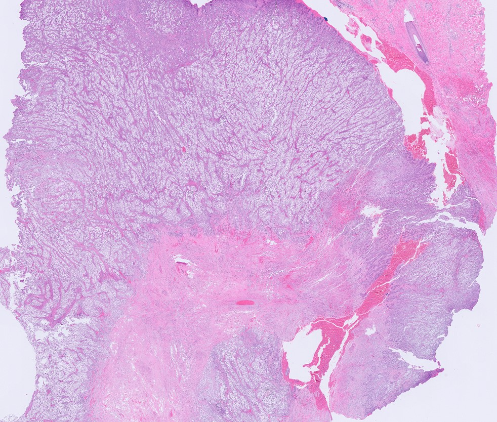 Microscopic image possibly detecting cancerous areas in human tissue