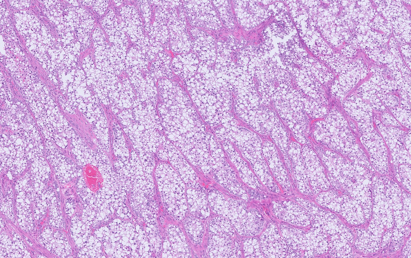 Microscopic image possibly detecting cancerous areas in human tissue