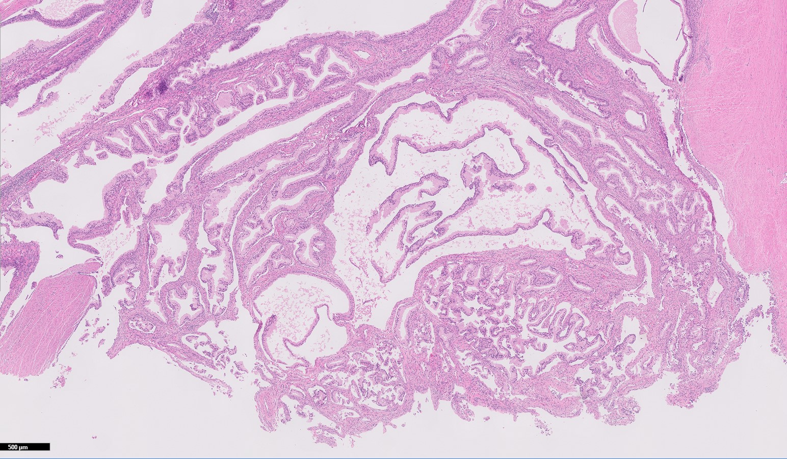 Microscopic image possibly detecting cancerous areas in human tissue