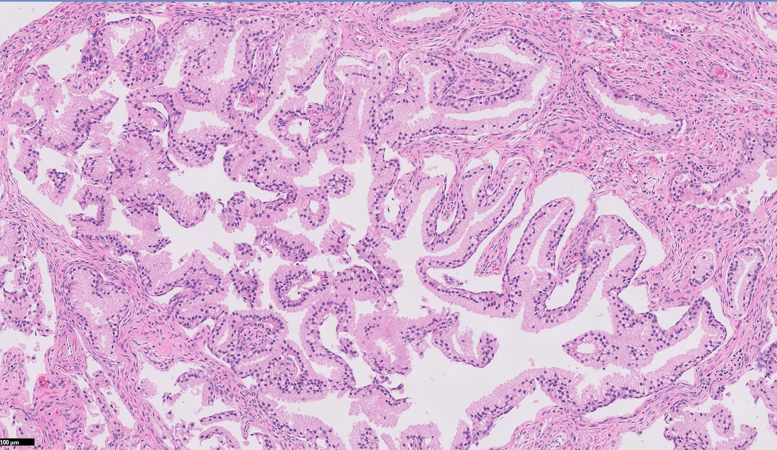 Microscopic image possibly detecting cancerous areas in human tissue