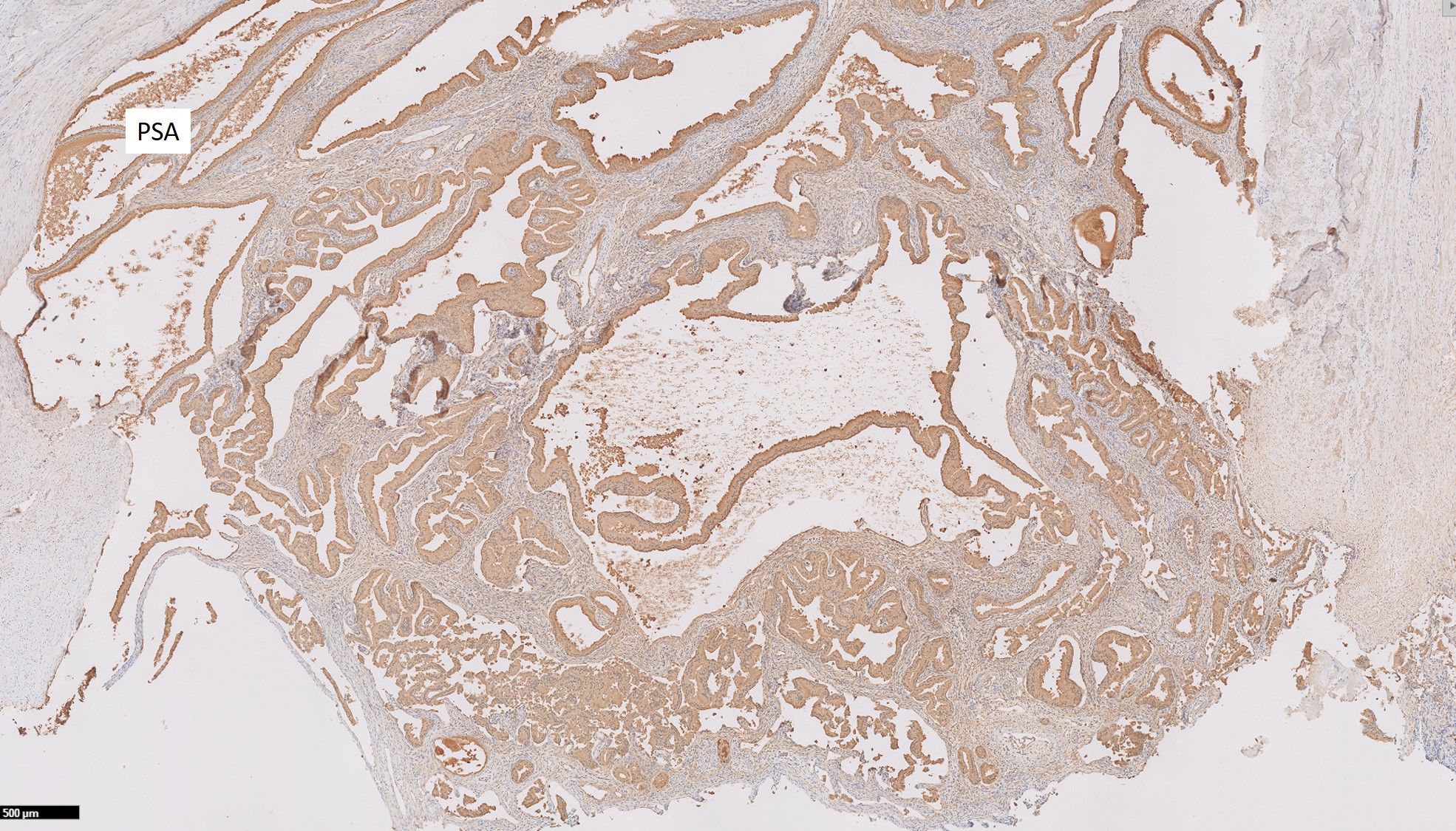 Microscopic image possibly detecting cancerous areas in human tissue