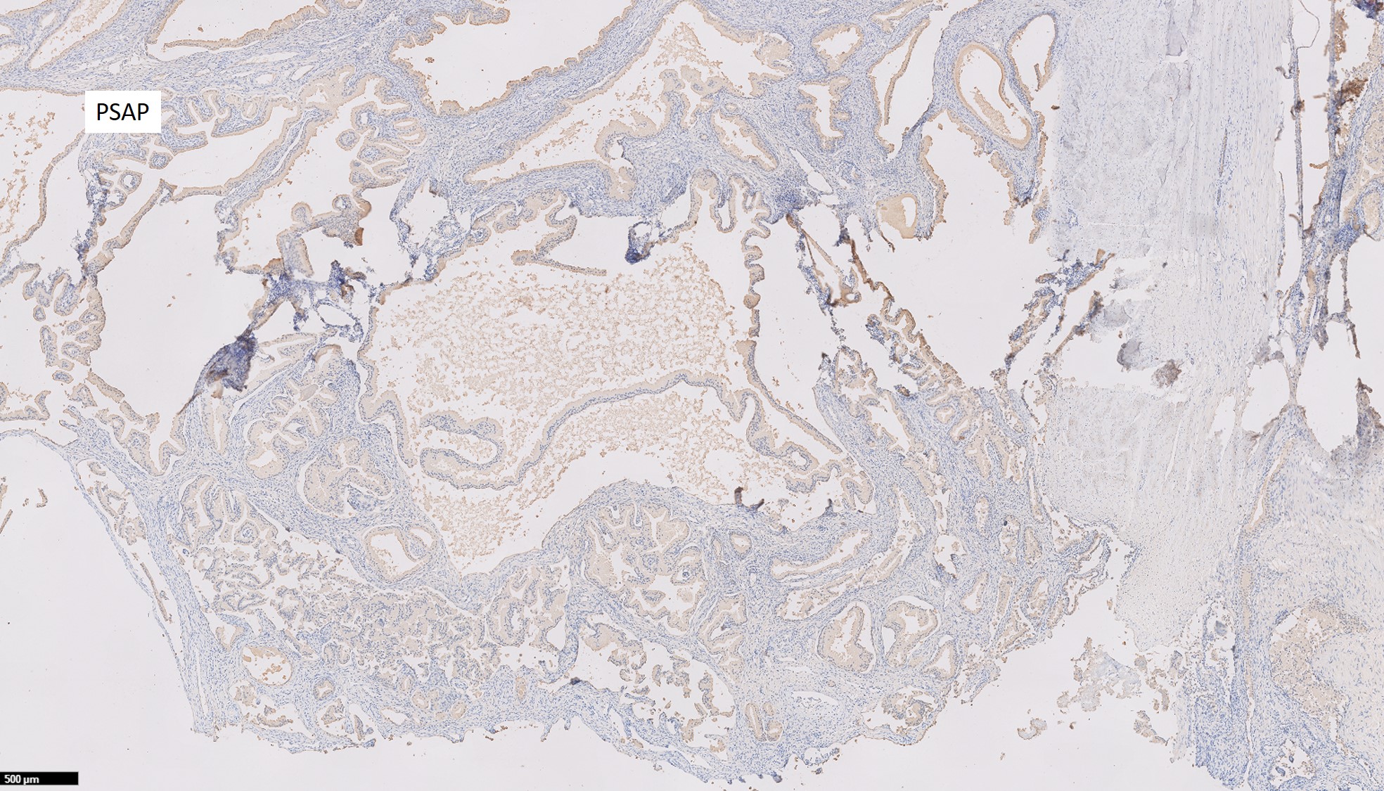 Microscopic image possibly detecting cancerous areas in human tissue