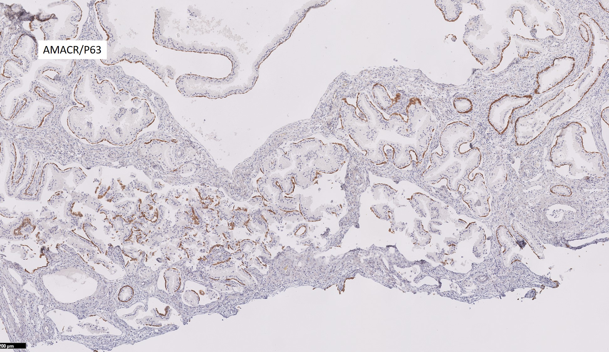 Microscopic image possibly detecting cancerous areas in human tissue