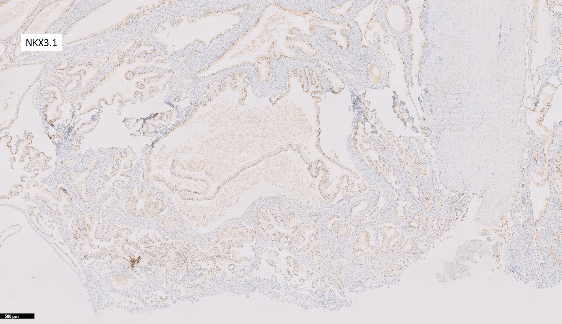 Microscopic image possibly detecting cancerous areas in human tissue