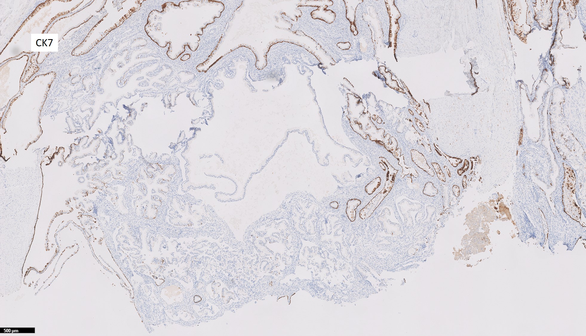 Microscopic image possibly detecting cancerous areas in human tissue