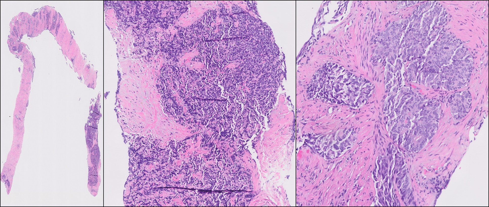 Microscopic image possibly detecting cancerous areas in human tissue