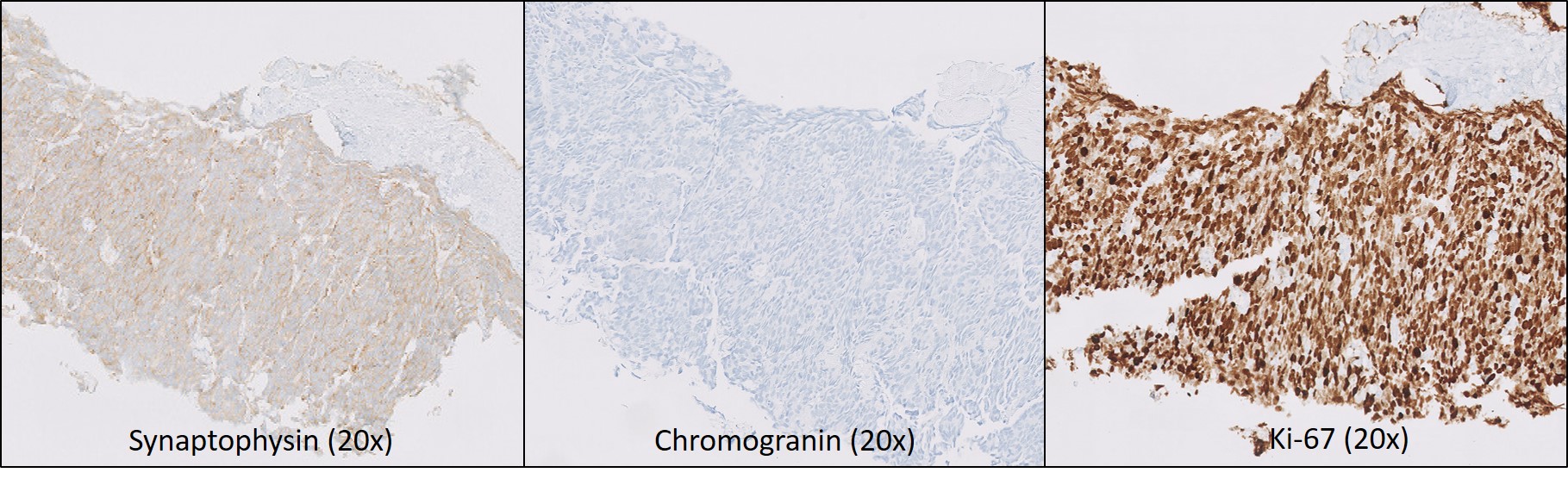 Microscopic image possibly detecting cancerous areas in human tissue