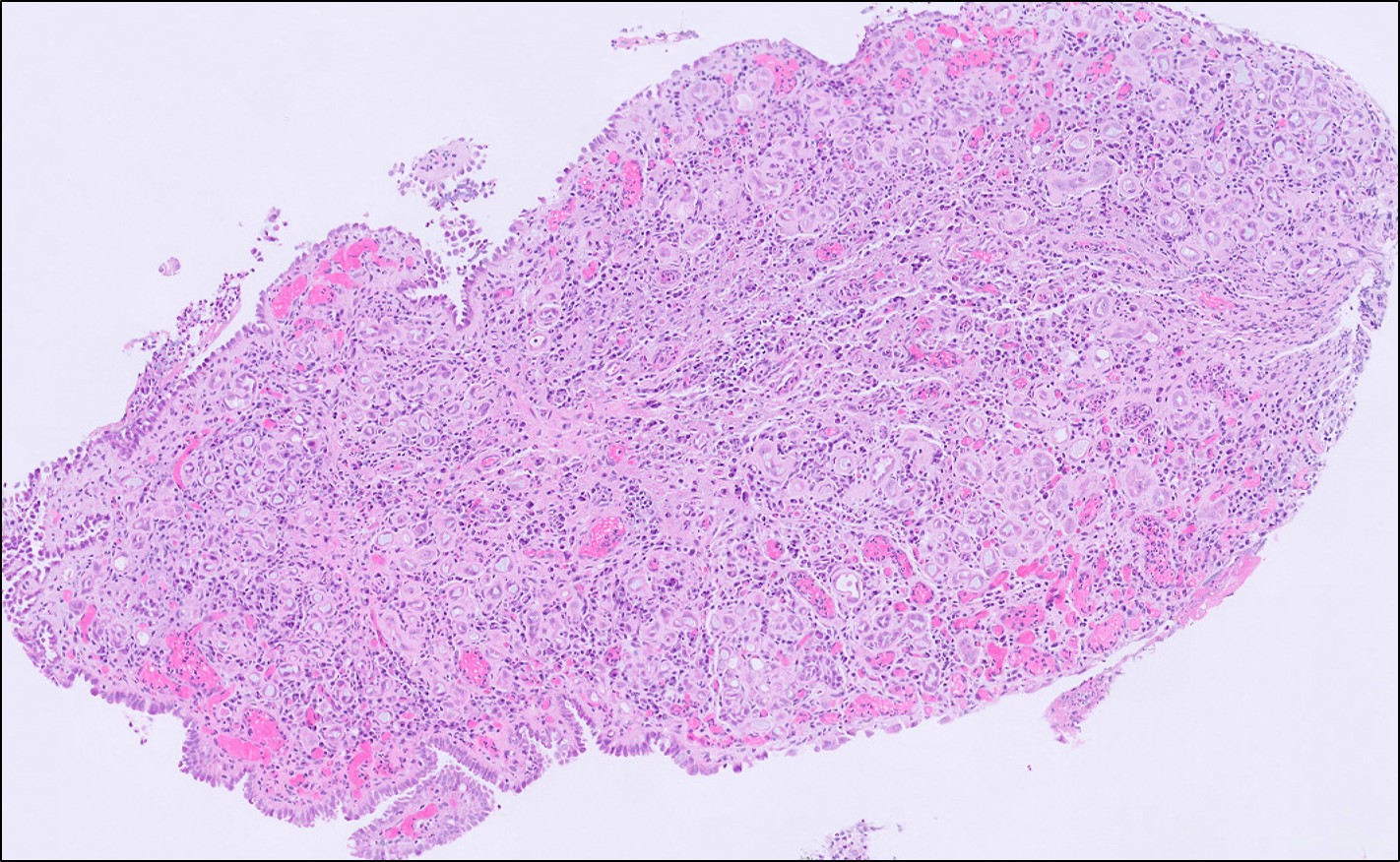 Microscopic image possibly detecting cancerous areas in human tissue