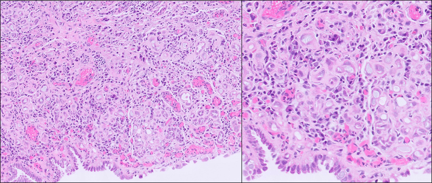 Microscopic image possibly detecting cancerous areas in human tissue