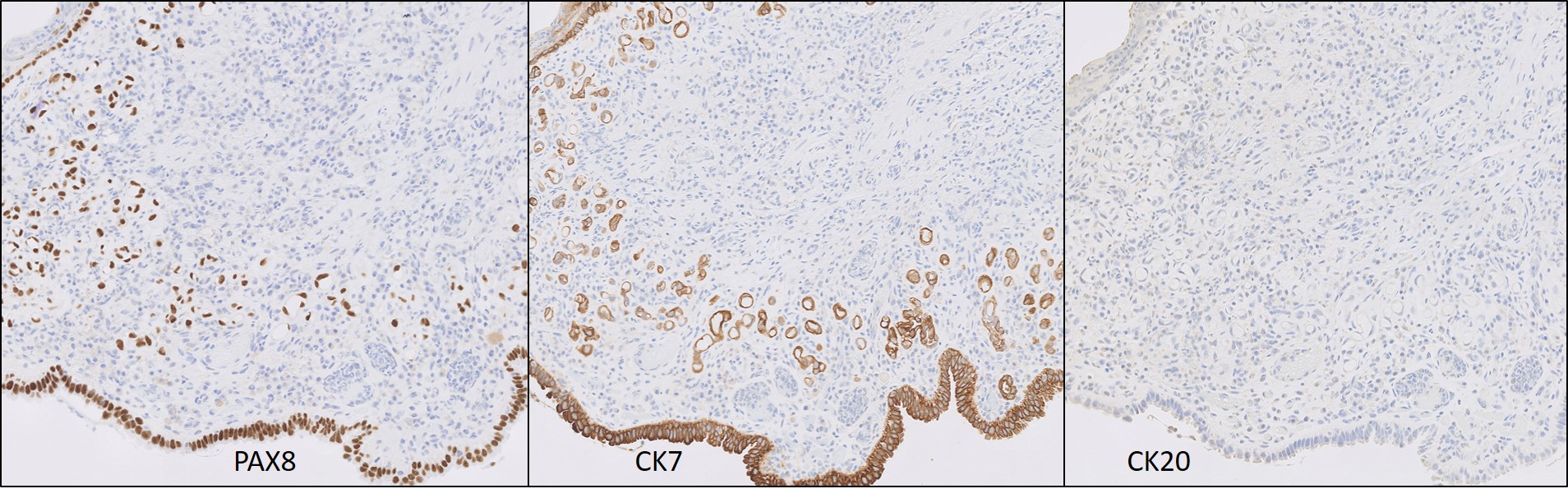 Microscopic image possibly detecting cancerous areas in human tissue