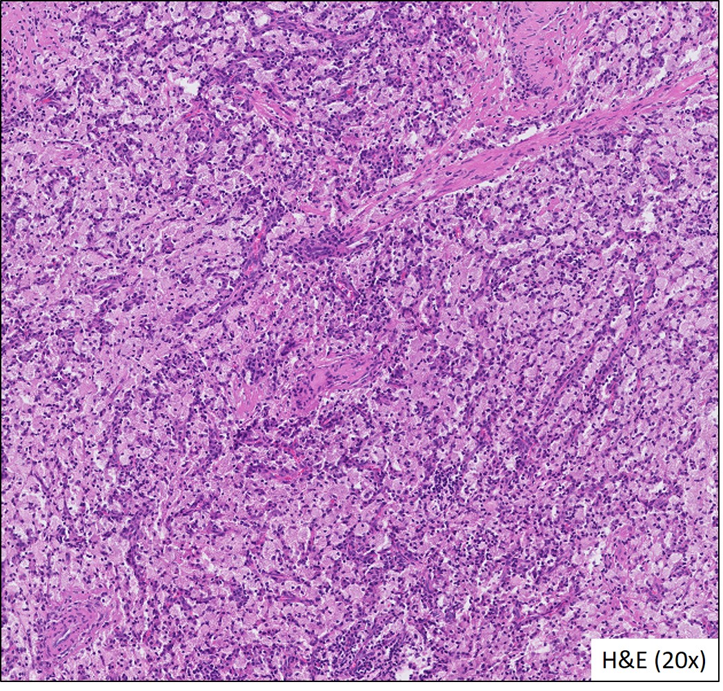 Microscopic image possibly detecting cancerous areas in human tissue