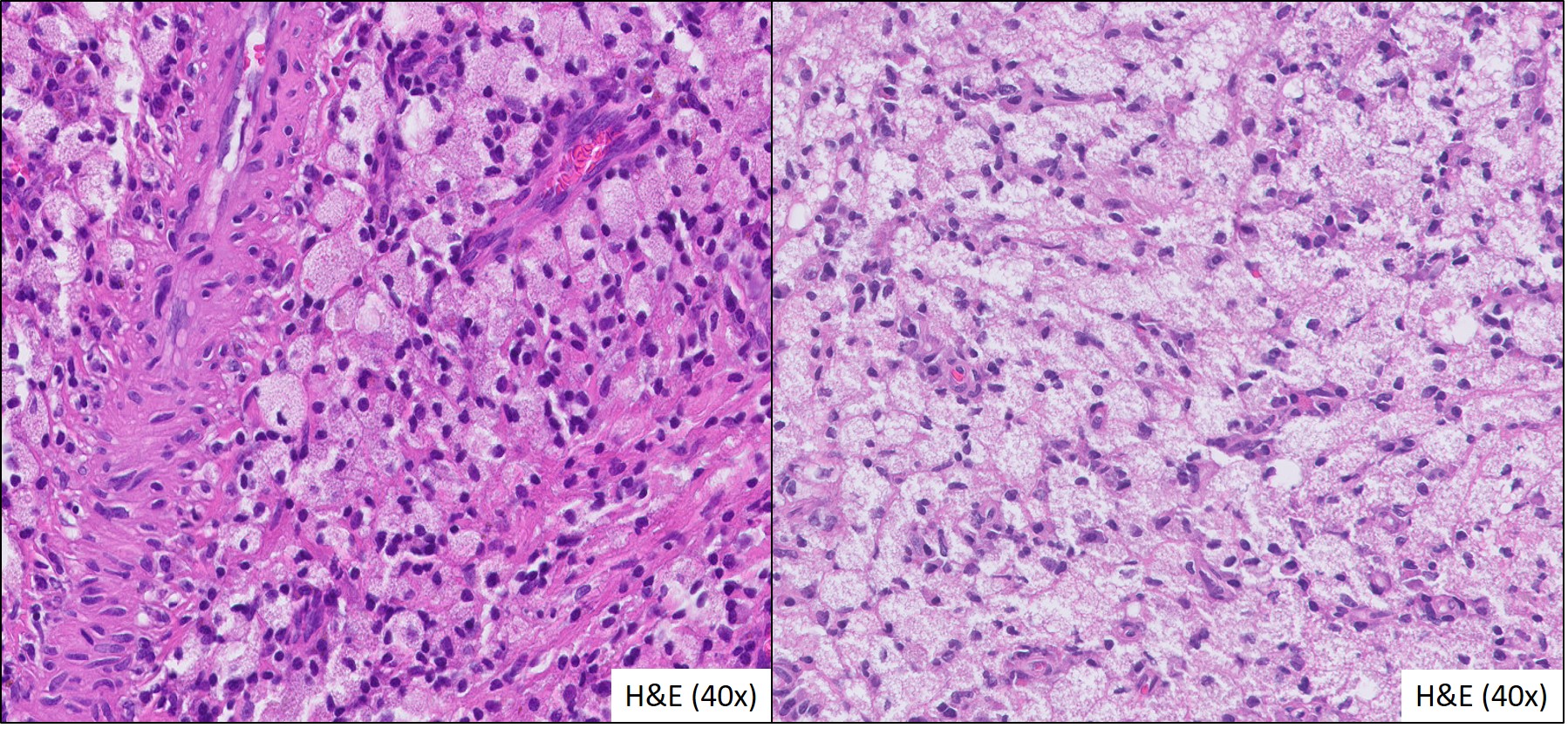 Microscopic image possibly detecting cancerous areas in human tissue