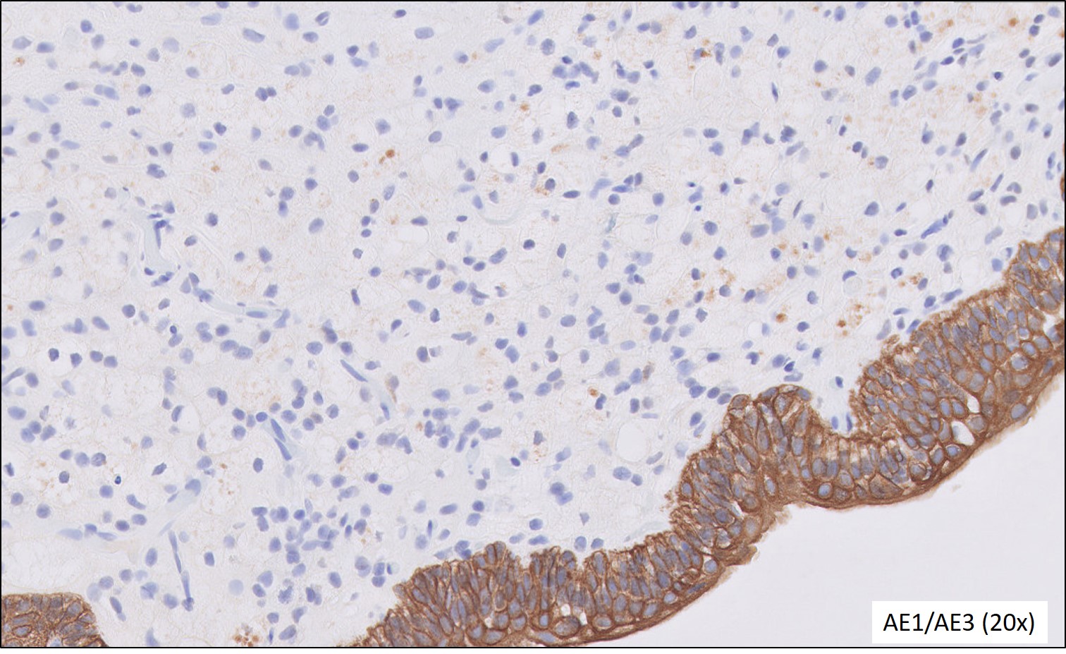 Microscopic image possibly detecting cancerous areas in human tissue