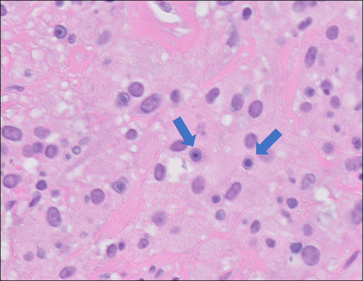 Microscopic image possibly detecting cancerous areas in human tissue