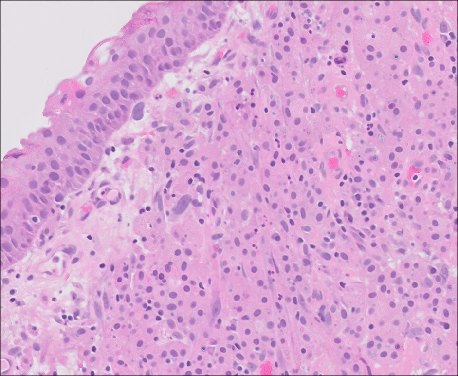 Microscopic image possibly detecting cancerous areas in human tissue