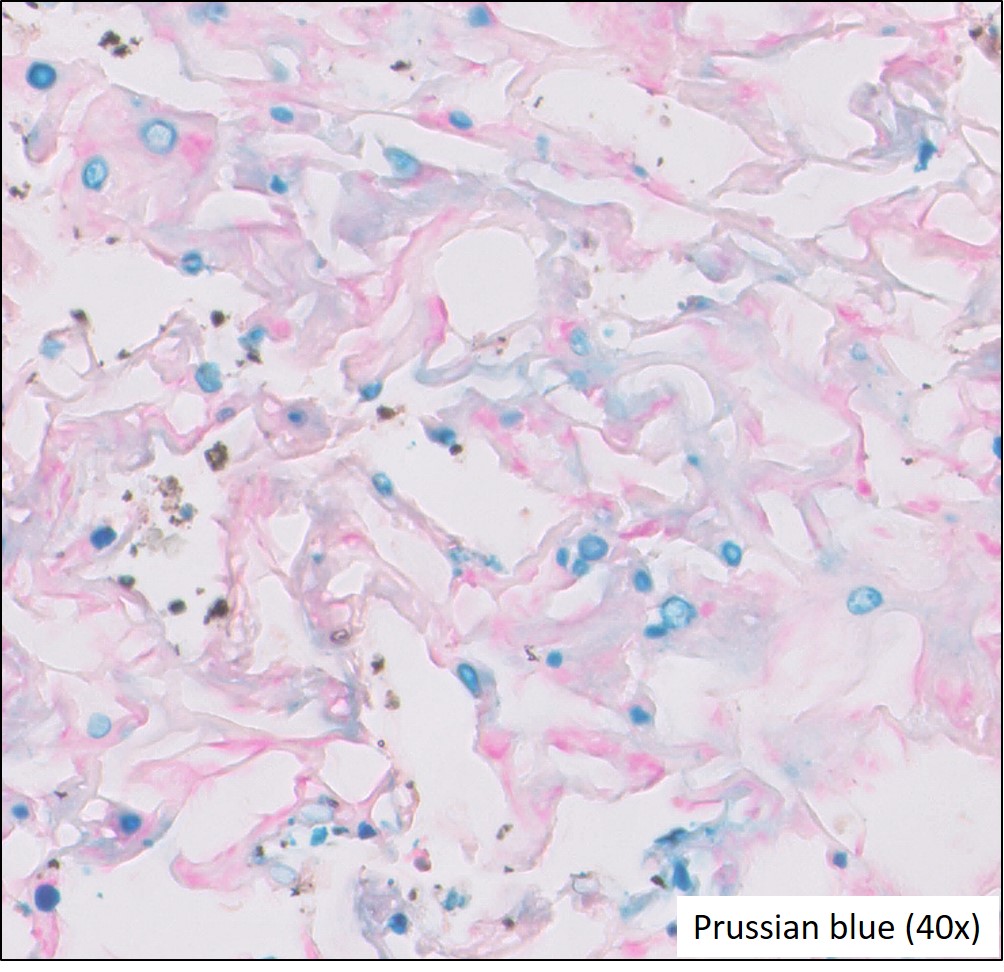 Microscopic image possibly detecting cancerous areas in human tissue