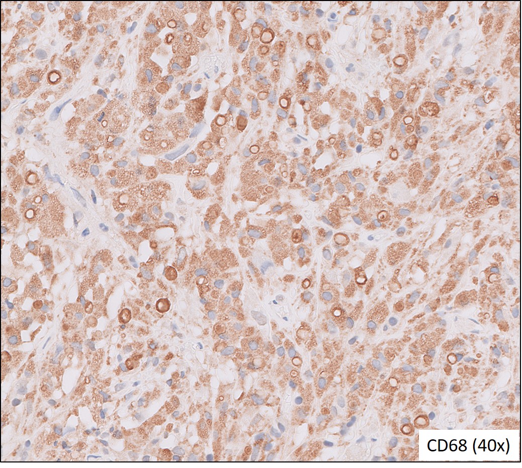 Microscopic image possibly detecting cancerous areas in human tissue