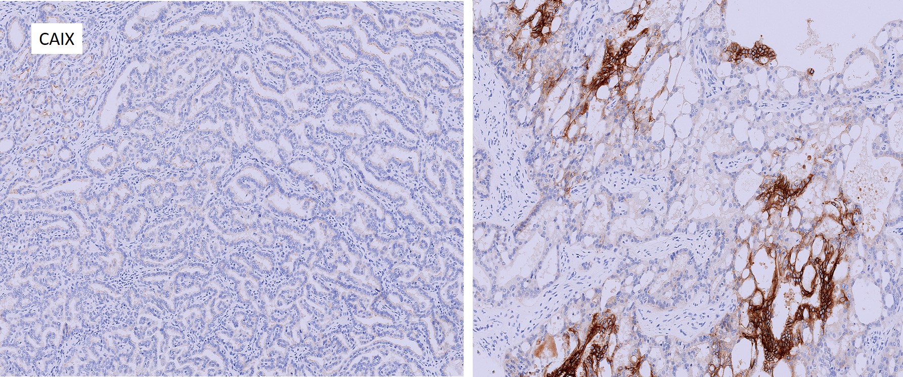 Microscopic image possibly detecting cancerous areas in human tissue