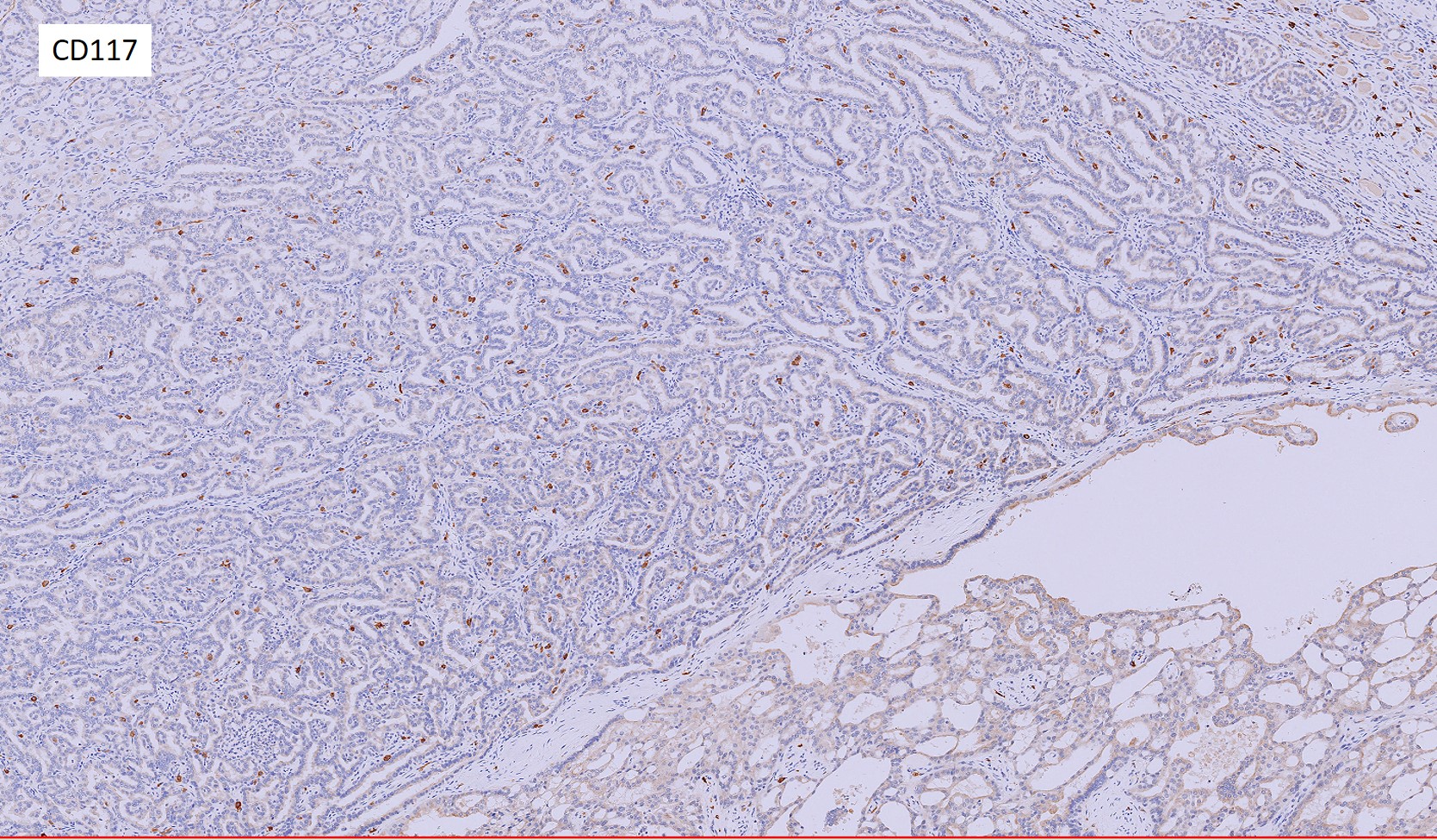 Microscopic image possibly detecting cancerous areas in human tissue