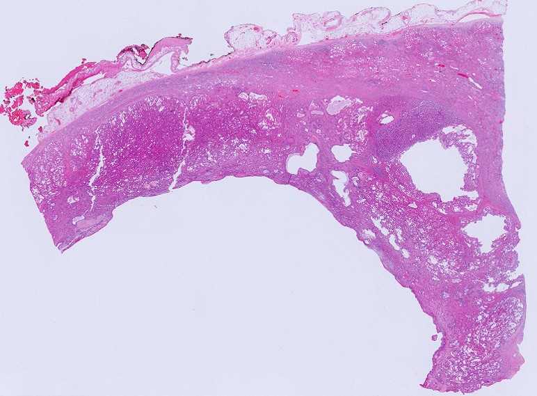 Microscopic image possibly detecting cancerous areas in human tissue