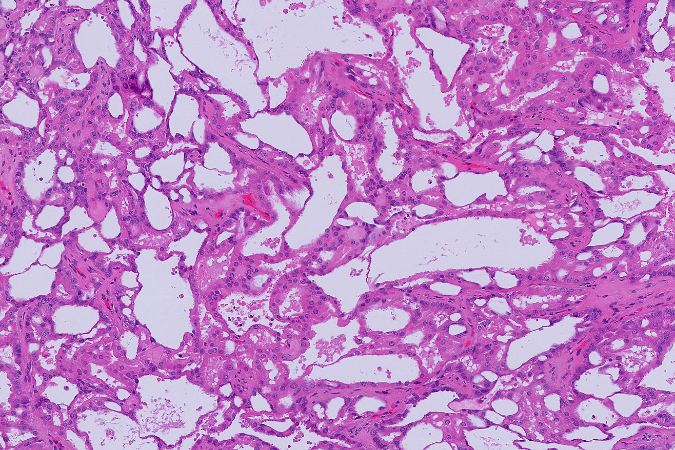 Microscopic image possibly detecting cancerous areas in human tissue