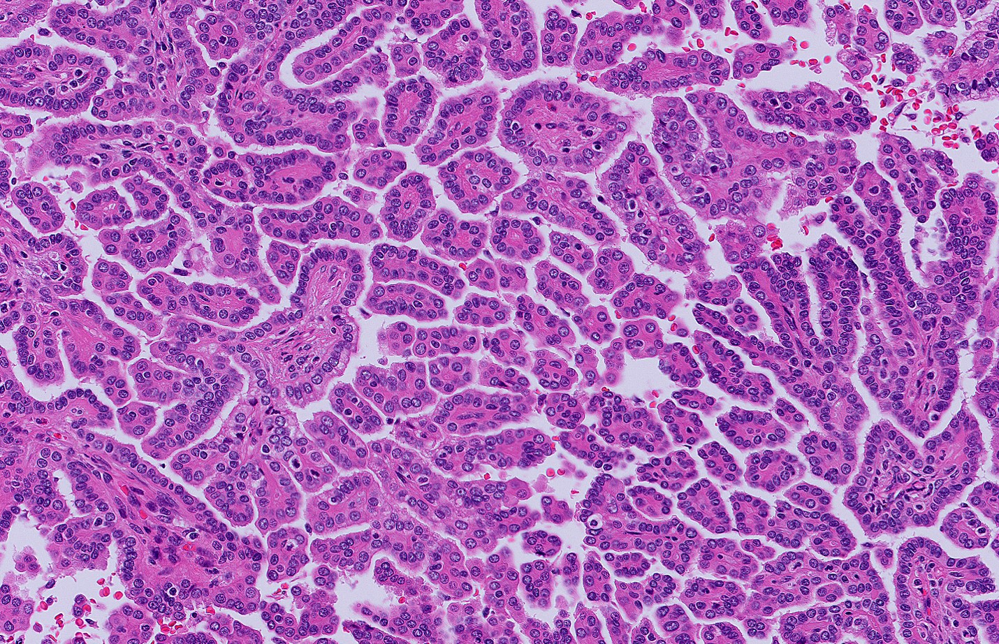 Microscopic image possibly detecting cancerous areas in human tissue