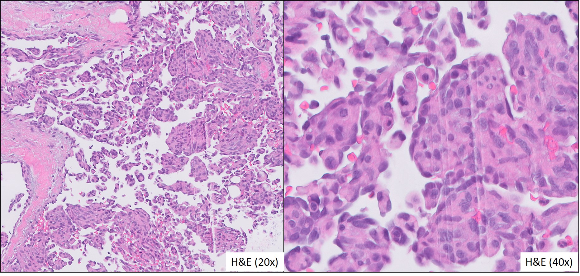 Microscopic image possibly detecting cancerous areas in human tissue