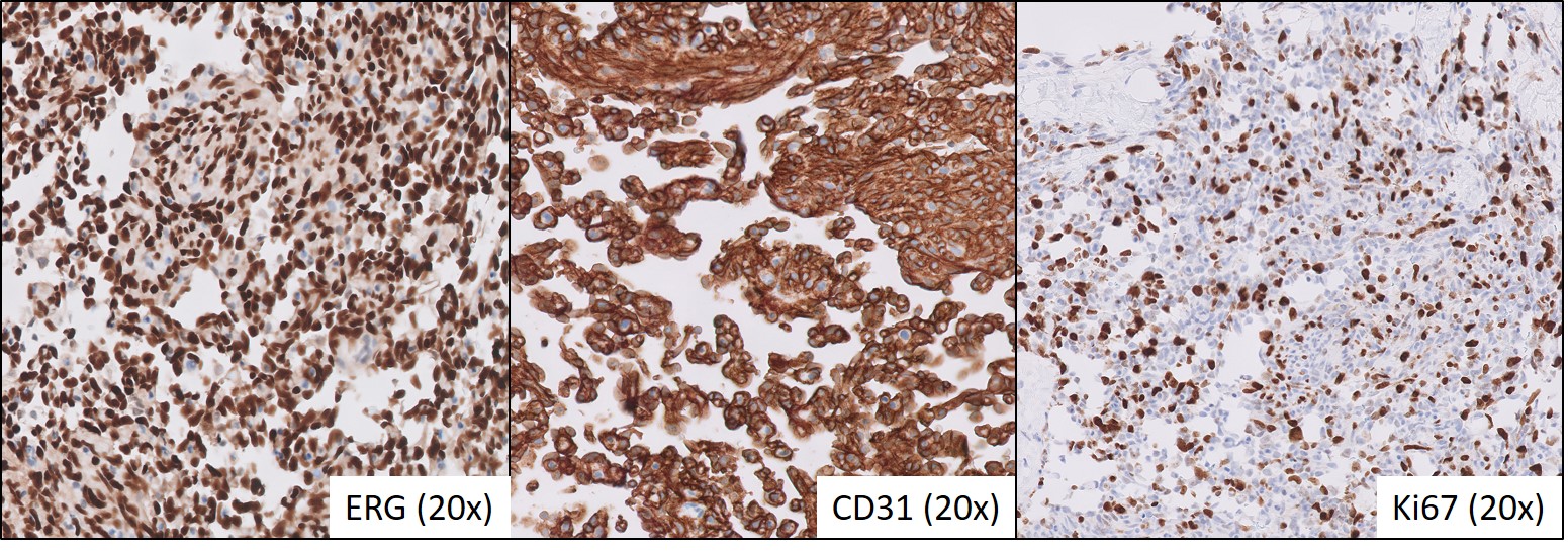 Microscopic image possibly detecting cancerous areas in human tissue