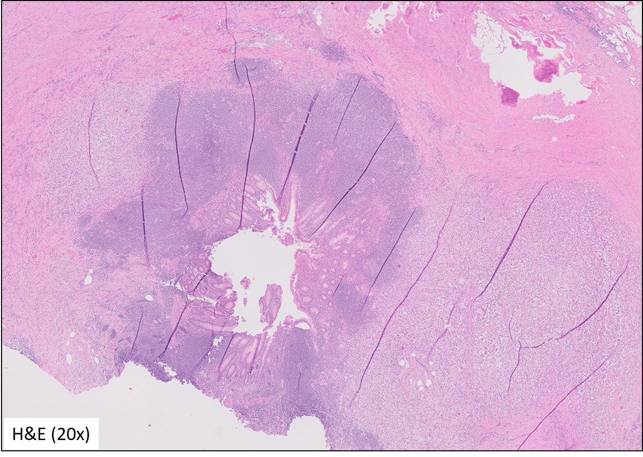 Microscopic image possibly detecting cancerous areas in human tissue